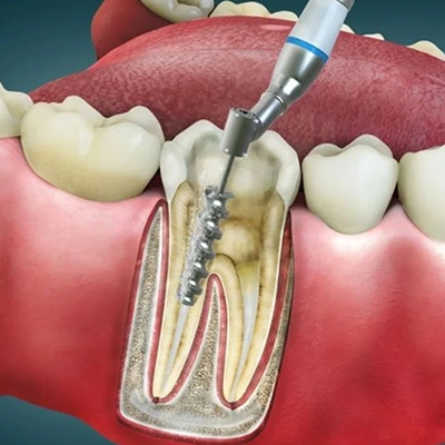 Get a new smile quickly with same-day dental implant solutions